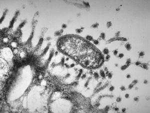 M,82y. | Helicobacter pylori - antrum pylori